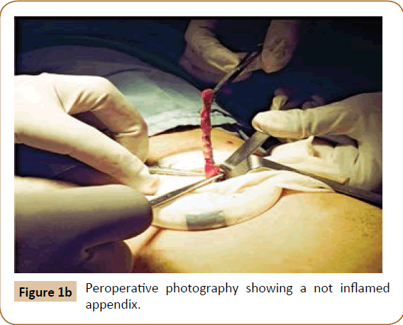 Primary Peritonitis In Immunocompetent Children Insight Medical Publishing