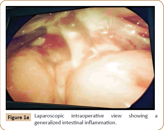 Primary Peritonitis In Immunocompetent Children Insight Medical Publishing